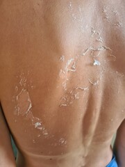 Peeling skin after sunburn on back.Human skin with dry flaky skin