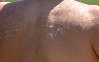 Burnt skin on the back of a man.