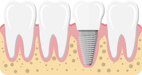 Tooth restoration, dental implant