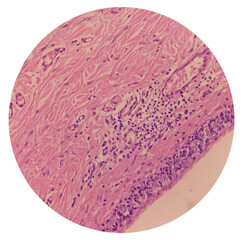 Microscopic image of branchial cyst, branchial sinus, show cyst wall of fibrocollagenous tissue by squamous epithelium.