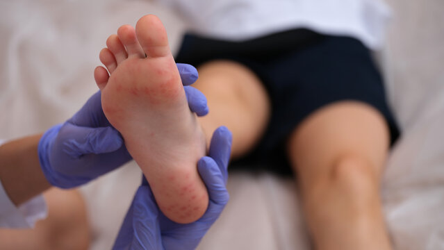 Infectious disease doctor examining rash on skin of child feet closeup