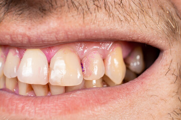 Plaque on human teeth is colored pink with indicator tablets.