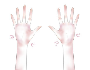 真っ赤に炎症している荒れた手のイラスト3