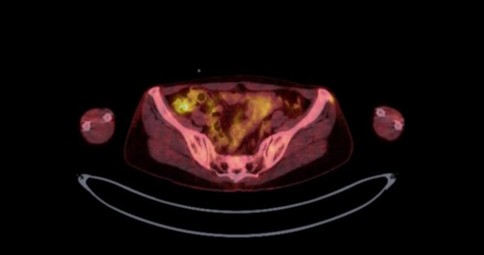 PET CT Scan fusion image of Whole human body  for detect cancer recurrence after surgery .
