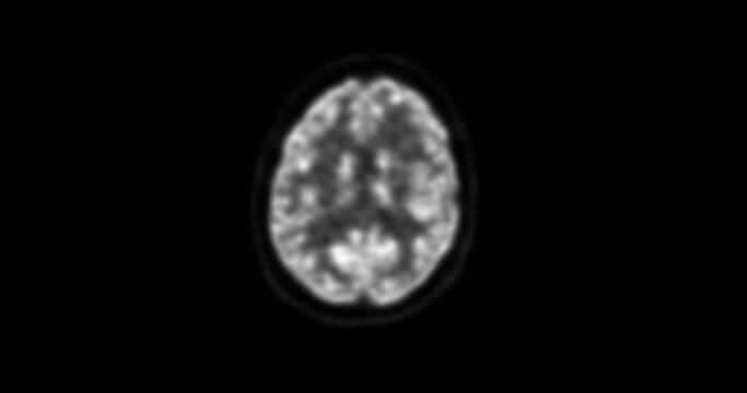 PET CT scan of Human Brain axial view (Positron Emission Tomography)