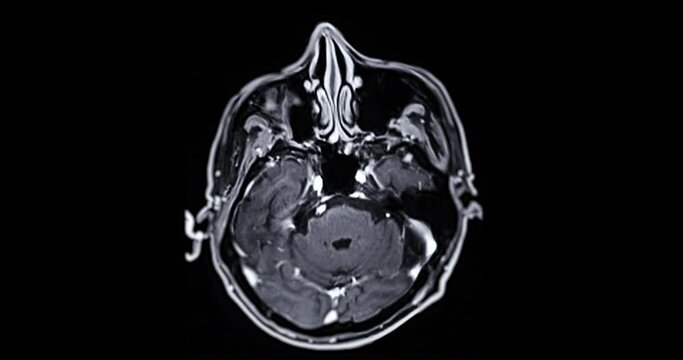 MRI of the brain with gadolinium contrast media for diagnosis brain tumor and stroke diseases . magnetic resonance imaging of the brain.