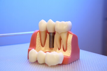 dental implant, model, plate, denture. Dental implant, artificial tooth roots into jaw, root canal...