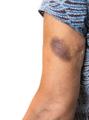 Senior arm with bruise. Woman with large blue and purple mark from falling or accident. Or...