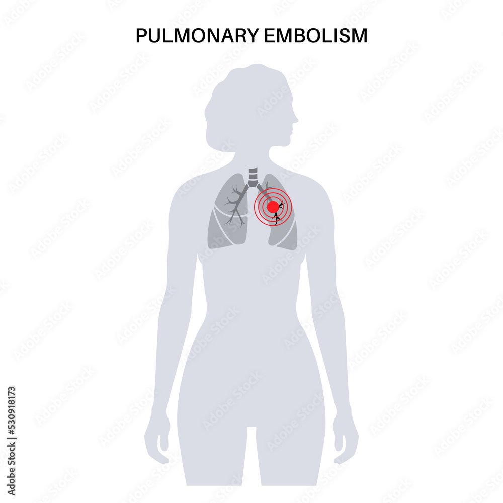 Wall mural Pulmonary embolism disease