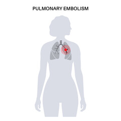 Pulmonary embolism disease