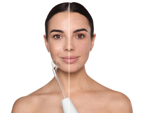 Collage with photos of young woman before and after using darsonval on white background, closeup