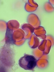 Red blood cells and white blood cell - blood smear.