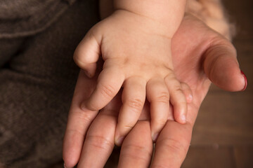 Polydactyly baby hand genetic condition