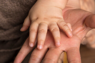 Polydactyly baby hand genetic condition