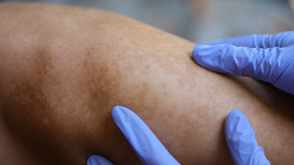 Doctor hands in rubber protective gloves check skin of young man with vitiligo or skin rashes