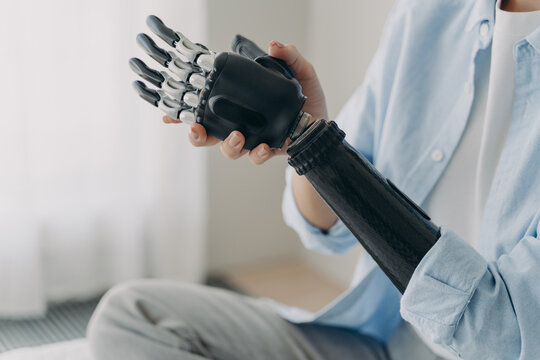 Person with disability puts together bionic prosthetic arm. Ad of high tech myoelectric prosthesis