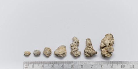 Kidney stones in different shapes from small to large.the concept of timely kidney treatment.