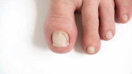 Titanium thread on the nail of the big toe. Ingrown toenail treatment