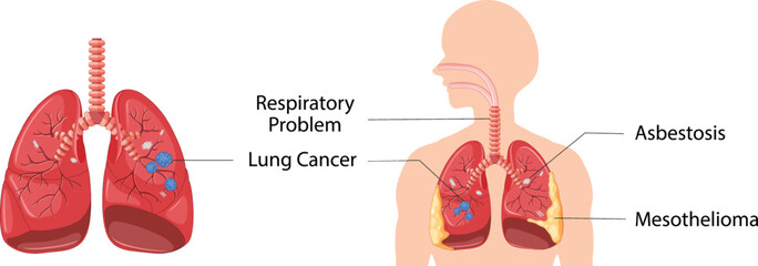 This image is for Lungs disease like Lung cancer for Asbestos fibre in the respiratory system. Respiratory diseases like Mesothelioma, Asbestosis mostly occur for Asbestos fibre from cement, sand etc.