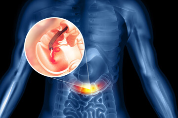 Colon cancer. colonoscope in the colon. polyp removal. 3d illustration - obrazy, fototapety, plakaty
