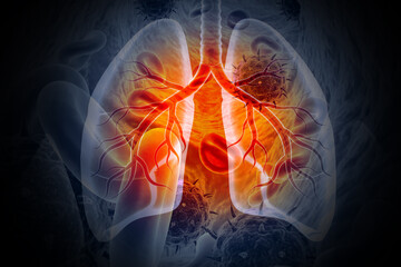 Medical Illustration showing lung cancer or bronchial carcinoma on medical background, 3d illustration