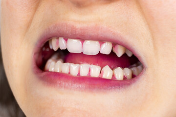 Plaque on human teeth is colored pink with indicator tablets.