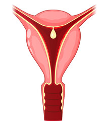 Uterine polyp. Human uterus with Endometrial polyp - obrazy, fototapety, plakaty