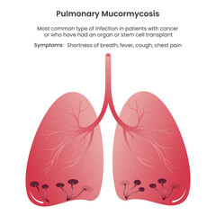 Pulmonary Mucormycosis vector illustration informational graphic