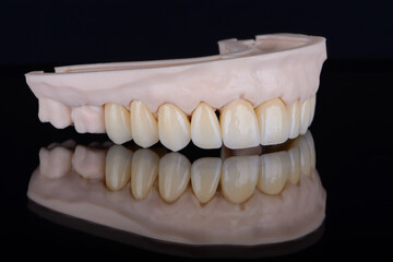 Quality dental prosthesis made of titanium beam and ceramics for fixation to the upper jaw. Teeth treatment.