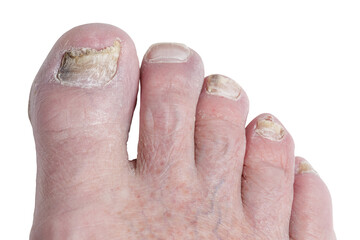 Close up of foot with toenail fungus or athletes foot