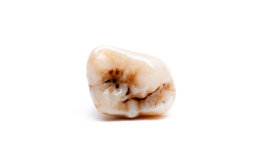 Close-up of a tooth with caries isolated on a white background. Removed wisdom teeth. Sick human teeth.