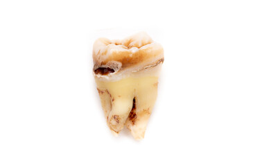 Close-up of a tooth with caries isolated on a white background. Removed wisdom teeth. Sick human teeth.