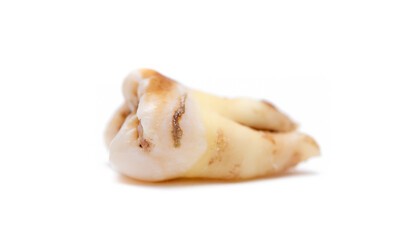 Close-up of a tooth with caries isolated on a white background. Removed wisdom teeth. Sick human teeth.