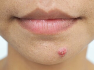 Inflammatory acne, pustular acne on the face of asian woman. Closeup photo, blurred.