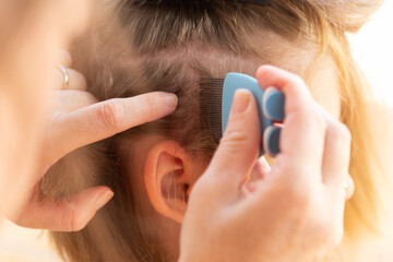 head lice head treatment,stock photography - obrazy, fototapety, plakaty