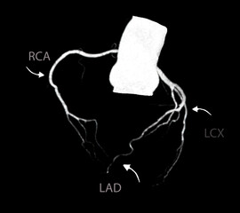 CT Cardiac 3D or CTA coronary artery