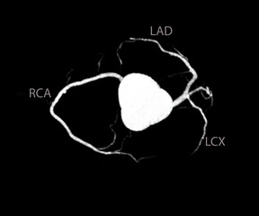 CT Cardiac 3D or CTA coronary artery