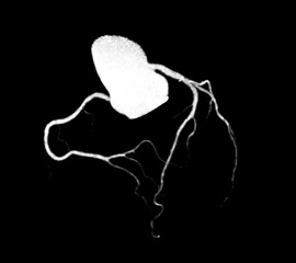 CT Cardiac 3D or CTA coronary artery