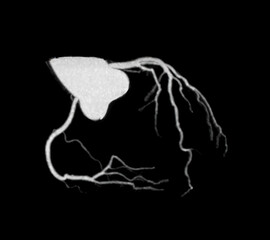 CT Cardiac 3D or CTA coronary artery