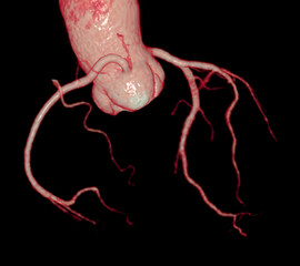 CT Cardiac 3D or CTA coronary artery