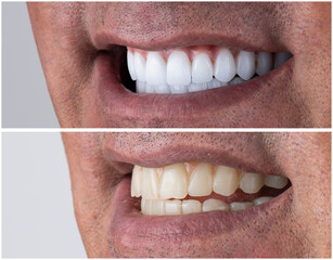 Obraz premium dental job photography, crowns veneers implants