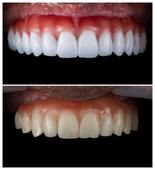 Obraz premium dental job photography, crowns veneers implants