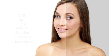 Post-Acne Marks .Treating Acne Scars.Acne Scar Removal.