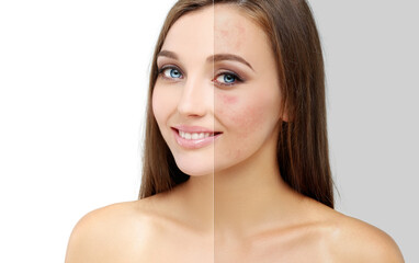 Post-Acne Marks .Treating Acne Scars.Acne Scar Removal.