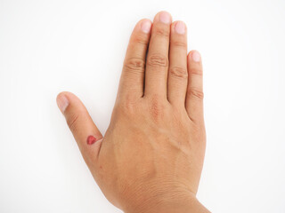 Thumb hurt with red cutout skin showing. Closeup photo, blurred.