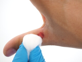Fototapeta premium Nurse wiping the wound on the thumb. Closeup photo, blurred.