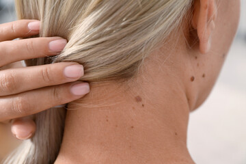 Fototapeta premium Closeup of woman`s body with birthmarks indoors, back view