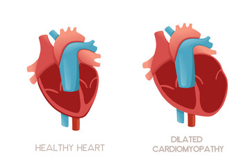 Healthy human heart and heart with dilated cardiomyopathy disease anatomy illustration health problem vector illustration on white background - obrazy, fototapety, plakaty