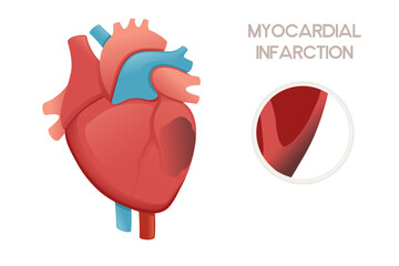 Unhealthy human heart with Myocardial infarction disease anatomy illustration health problem vector illustration on white background