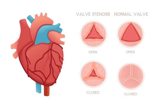 Healthy human heart with valves and valve stenosis disease anatomy illustration health problem vector illustration on white background
